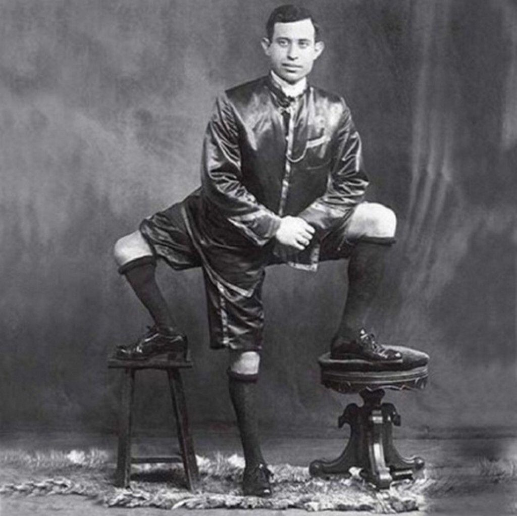 Frank Lentini had three legs along with other body parts due to a conjoined parasitic twin.
