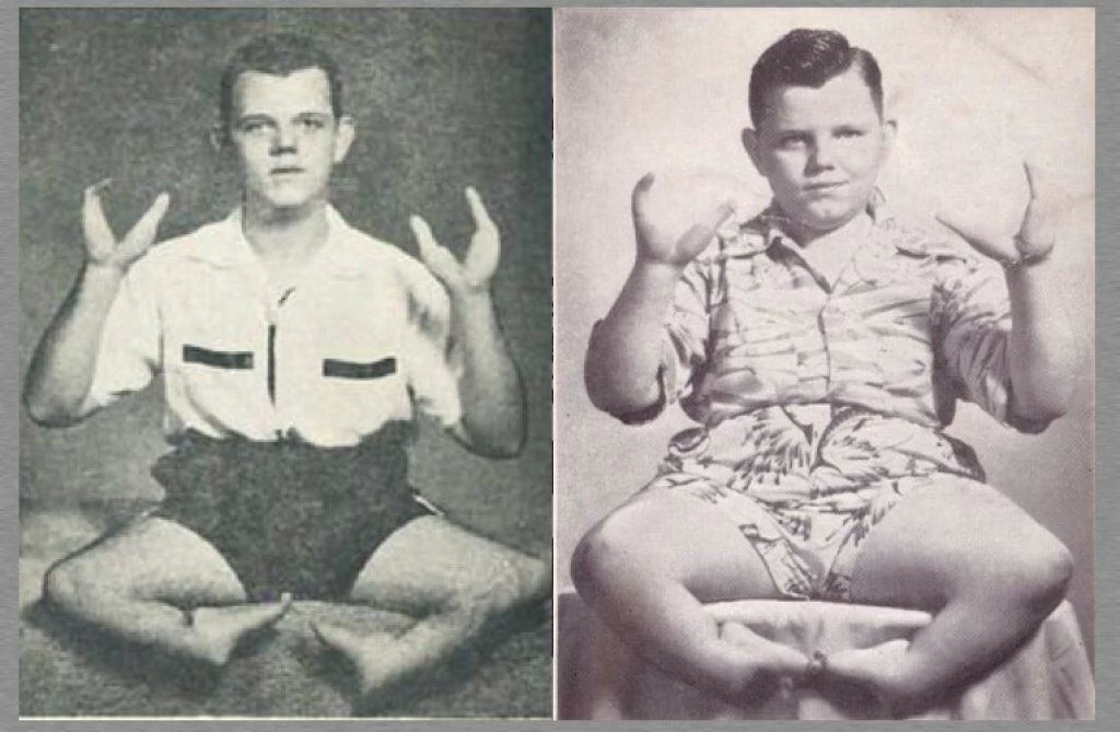 lobster boy grady stiles